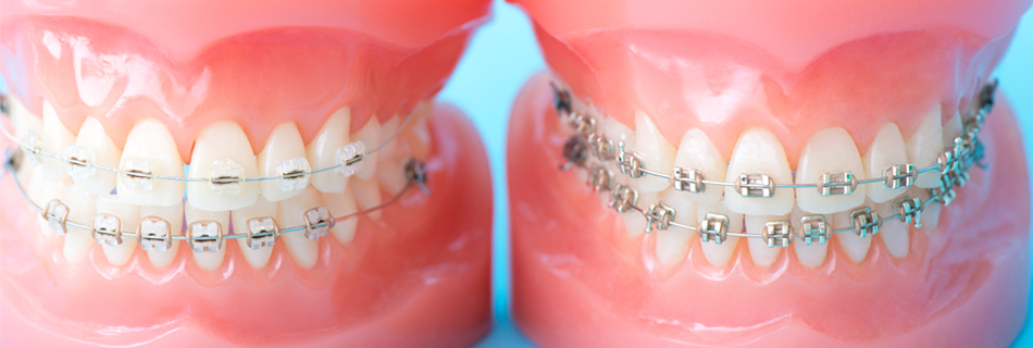 装置をつけて歯をならべる本格的な治療